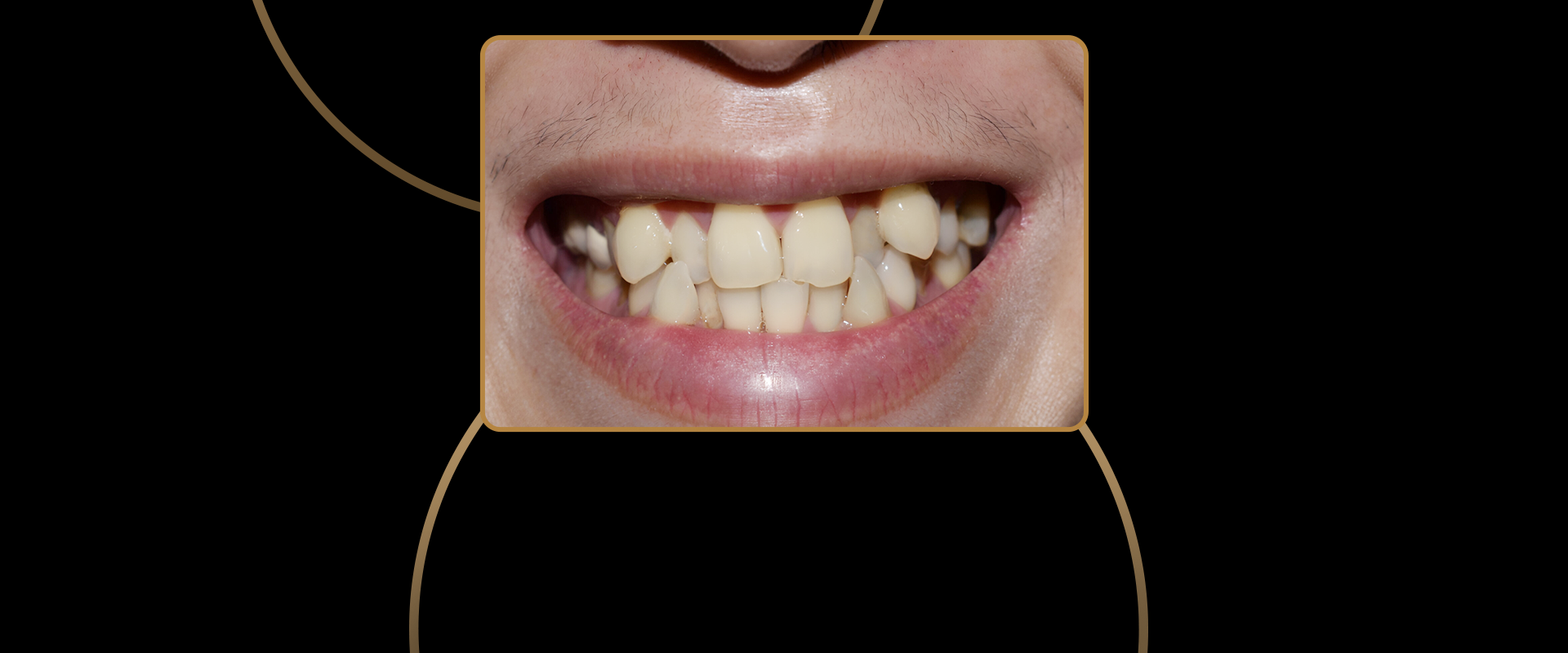 Invisalign for Crowded Teeth